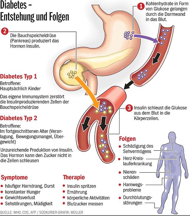 Gesundheit Die Umstrittene Diabetes Vorstufe Sudkurier Online