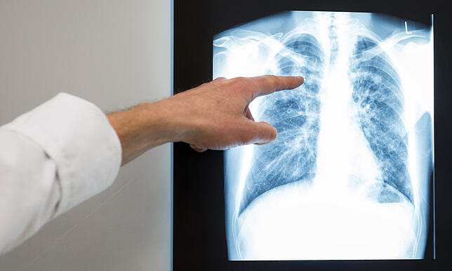 Röntgenbild Lunge Ein Arzt zeigt auf das Röntgenbild einer Lunge. Mehr als hundert Lungenspezialisten bezweifeln den gesundheitlichen Nutzen der aktuellen ...