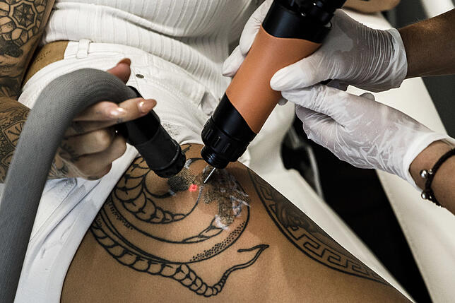 Tattooentfernung Wenn Tattoos Wieder Verschwinden Sollen Sudkurier Online